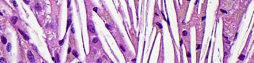 Lichtmikroskopische Aufnahme von Cholesterinspalten