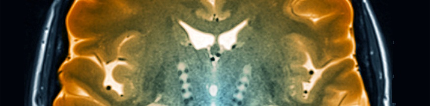 Morbus Parkinson, MRT-Scan