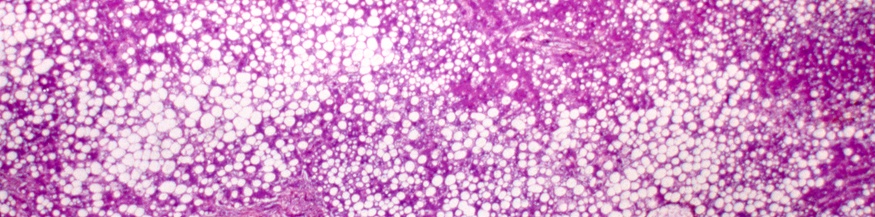 Mikroskopische Aufnahme einer Fettleber