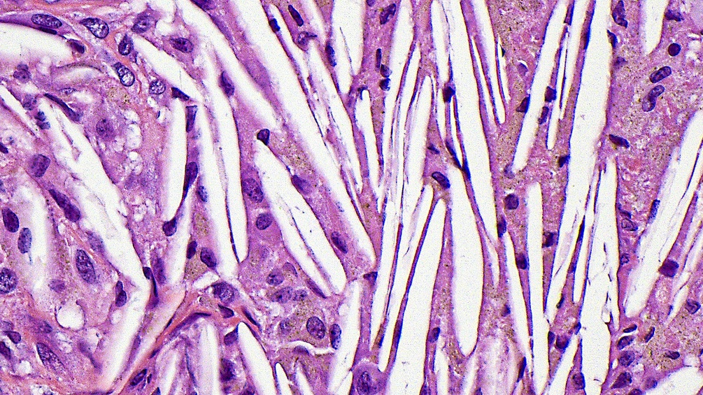 Lichtmikroskopische Aufnahme von Cholesterinspalten