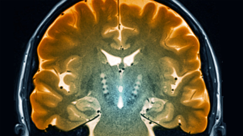 Morbus Parkinson, MRT-Scan