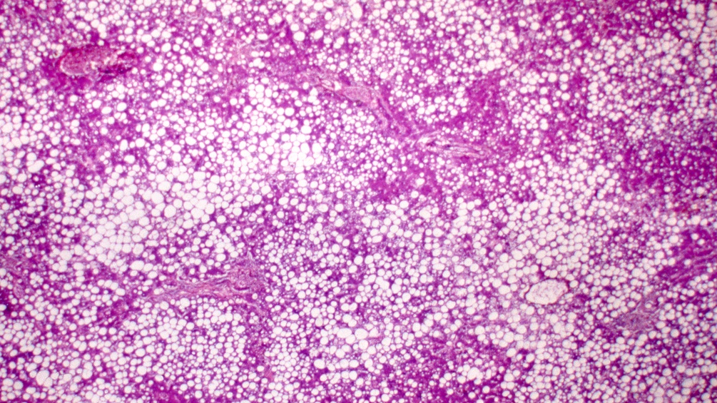 Mikroskopische Aufnahme einer Fettleber