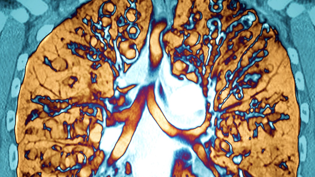 CT-Scan einer Lunge: zystische Fibrose