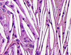 Lichtmikroskopische Aufnahme von Cholesterinspalten