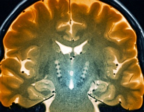 Morbus Parkinson, MRT-Scan