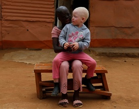 Ein Kind mit Albinismus in Afrika mit ihrer Schwester.