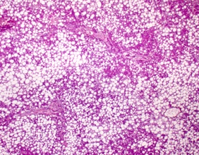 Mikroskopische Aufnahme einer Fettleber