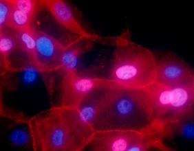 Brustkrebs Zellen