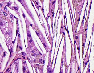 Lichtmikroskopische Aufnahme von Cholesterinspalten