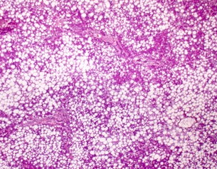 Mikroskopische Aufnahme einer Fettleber