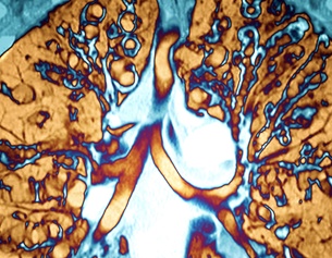 PICTUREDESK.COM/SCIENCE PHOTO LIBRARY CT-Scan einer Lunge: zystische Fibrose